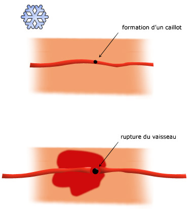 Brûlure - La rougeur provient de la rupture de très fins vaisseaux sanguins superficiels.
