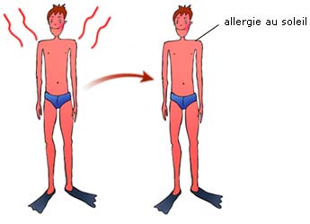 allergie au soleil