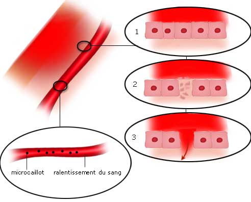 Atteinte des capillaires sanguins