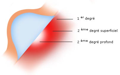 brûlure plusieurs degré