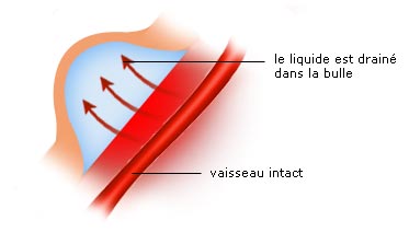 brûlure superficielle