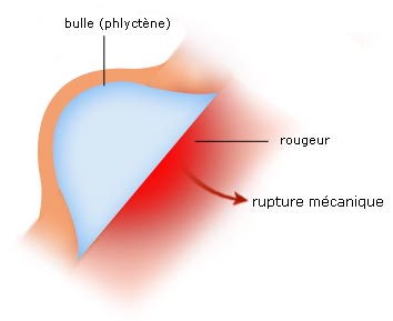 Coup de soleil du second degré superficiel