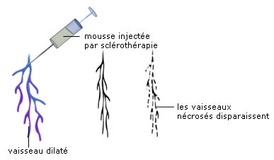 éclatement des vaisseaux