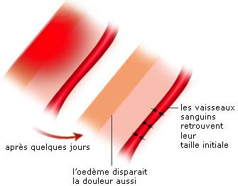 Les jours qui suivent la brûlure - Brûlure