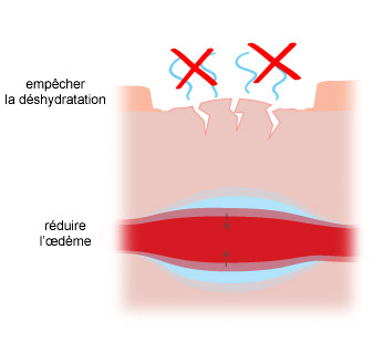 réduire l'oedème