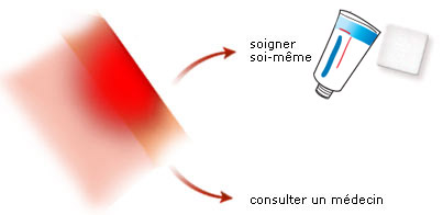 Peut-on soigner soi-même ? - Brûlure