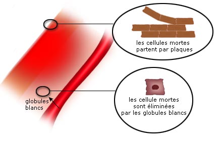 Les jours qui suivent la brûlure - Brûlure