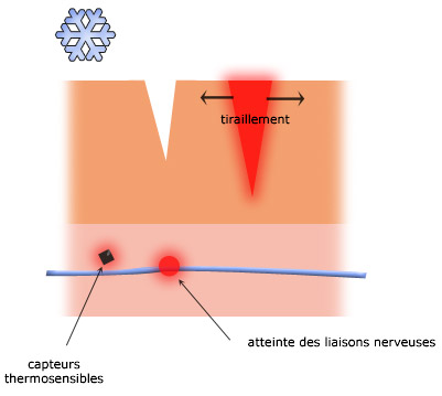 Douleur - brûlure par le froid